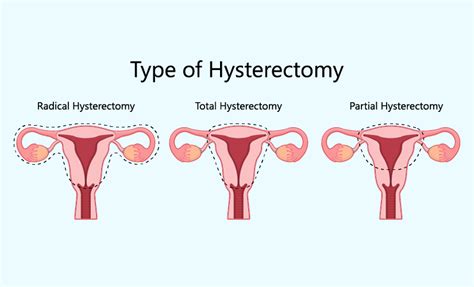 hysterectomy in chesterfield|Hysterectomy in Chesterfield: top 10 doctors .